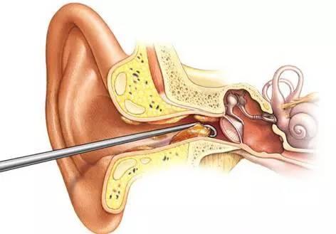 新生儿听力检查仪提示家长，孩子佩戴助听器应该注意对耳朵的保养